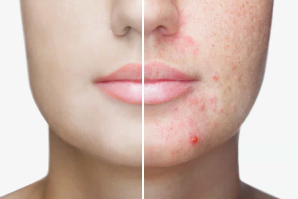 Adult Acne Facial Prices