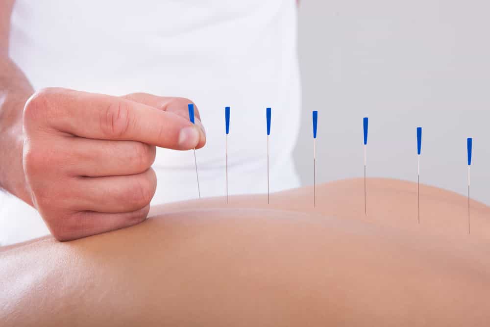 needling therapy