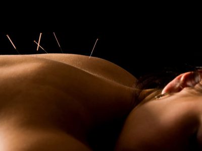 Acupuncture Massage therapy
