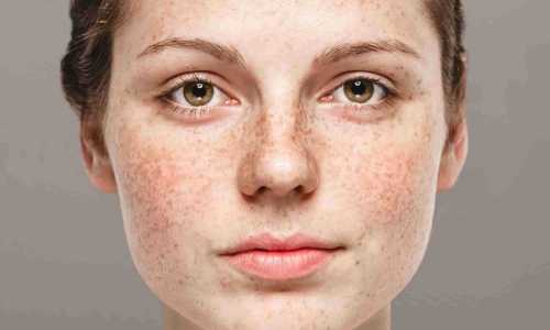 soothes irritated skin treatment by mississauga best massage therapist